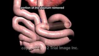 What is Intussusception  Pathology mini tutorial [upl. by Carnes91]