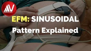 Sinusoidal pattern explained [upl. by Artie]