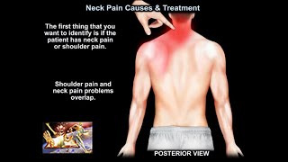 Common Causes of Neck Pain [upl. by Irotal530]