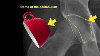 Ultrasound guided hip joint injection [upl. by Rozamond]