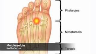 Metatarsalgia Foot Pain Causes Symptoms amp Treatments [upl. by Asiled577]