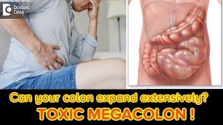 Toxic Megacolon Signs Symptoms amp TreatmentStomach Pain DiarrheaDr Ravindra BS Doctors Circle [upl. by Ycal]