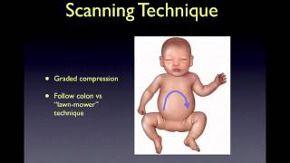 intussusception [upl. by Fee]