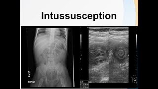 Intussusception [upl. by Aisanahta174]