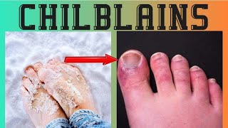 Chilblains causes symptoms treatment urduhindi [upl. by O'Driscoll539]