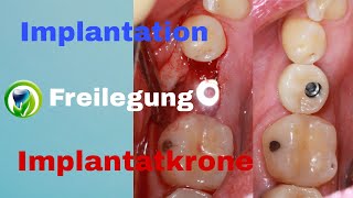 Zahnimplantation Freilegung Abformung Implantatkrone  Ablauf  Zeitraum  Dauer  Termine [upl. by Tekcirc]