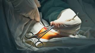 New bulging vein procedure [upl. by Clementina]