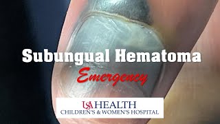 Subungual Hematoma Emergency and Trephination Procedure [upl. by Adnauqal]