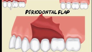 Periodontal Flap [upl. by Ahseinad]