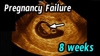 Early pregnancy failure 8 weeks 2 days [upl. by Rivi]