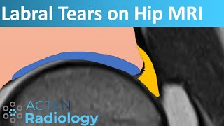 Labral Tears on Hip MRI [upl. by Iral]