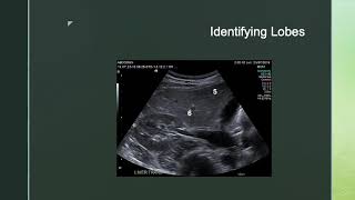 Ultrasound and Liver Segments [upl. by Eicyak]