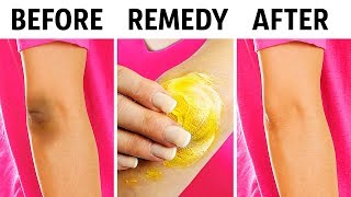 10 Natural Tricks to Remove Dark Knees and Elbows [upl. by Ymer219]