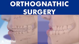 ORTHOGNATHIC surgery  All about JAW realignment surgery © [upl. by Akinam]