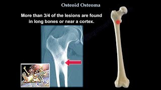 Osteoid Osteoma  Everything You Need To Know  Dr Nabil Ebraheim [upl. by Llerret]