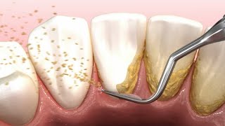 Dental scaling teeth animation [upl. by Roban]