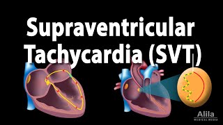 Supraventricular Tachycardia SVT PSVT Animation [upl. by Enomis803]