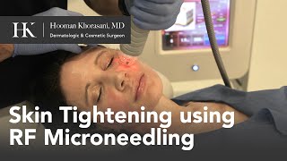 Skin Tightening of the Face using RadioFrequency RF Microneedling by Dr Hooman Khorasani [upl. by Dennard]