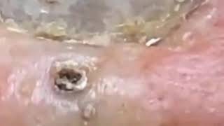 Blackheads • Nose Blackheads • Blackheads 2021 New • Blackheads On Nose • Blackheads Nose [upl. by Hally]