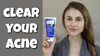 HOW TO CLEAR YOUR SKIN WITH BENZOYL PEROXIDE DR DRAY [upl. by Aitahs]