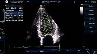 Ejection fraction measurement [upl. by Eloccin]