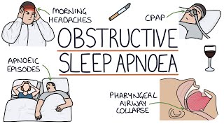 Obstructive Sleep Apnoea [upl. by Pietrek]