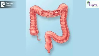 Ultrasound guided Hydrostatic Reduction of Intussusception [upl. by Leund]