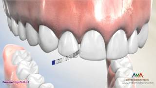 Interproximal Reduction or IPR  Polishing Strip [upl. by Hendrik]