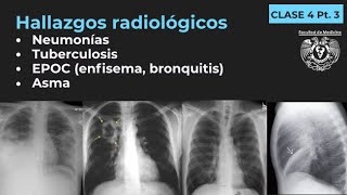 043  Neumonía TB EPOC Enfisema Bronquitis Bronquiectasias Asma [upl. by Kacerek]