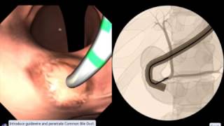 EndoSim Endoscopic Retrograde Cholangiopancreatography  ERCP [upl. by Mcclary]