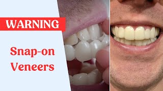 Snap On Veneers Warning [upl. by Camm]