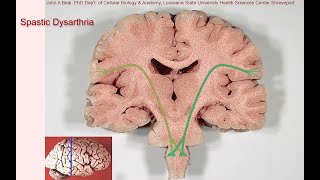 Spastic dysarthria  samples and tutorial [upl. by Yerrot629]