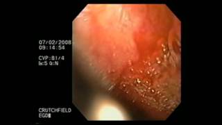 Esophagogastroduodenoscopy [upl. by Johppa]