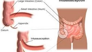 Intussusception [upl. by Edlyn]