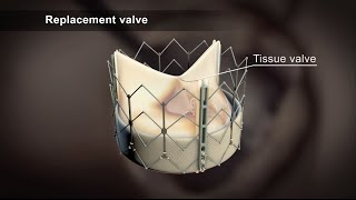 Ultrasound of Abdominal Aortic Aneurysm AAA [upl. by Yrailih484]