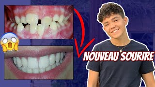 TOUT SUR MES DENTS évolution douleurs [upl. by Oravla]