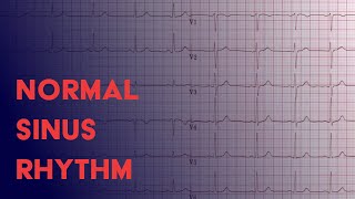 Normal Sinus Rhythm  EKG ECG Interpretation [upl. by Anabella]