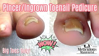 HOW TO REVERSE AND CURE PINCER TOENAILS [upl. by Tomlinson62]