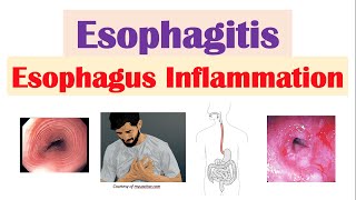 Esophagitis Esophagus Inflammation Causes Risk Factors Signs and Symptoms Diagnosis Treatment [upl. by Sible412]