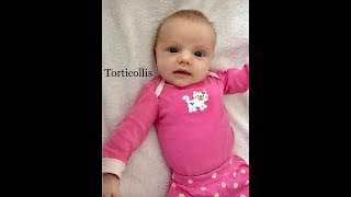 Chapter 2 Torticollis Infant Repositioning for Plagiocephaly [upl. by Aztirak]