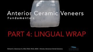 Anterior Ceramic Veneers Part 4 Lingual Wrap [upl. by Roley]