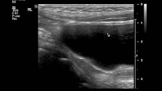 Intussusception US and Reductionmp4 [upl. by Ashok]