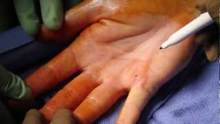 5 Dupuytrens Contracture [upl. by Aseeram]