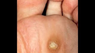 What Are Plantar Warts Dr Mikkel Jarman Pediatric Podiatrist [upl. by Ettesus]