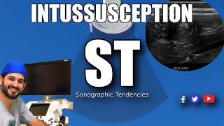 Intussusception Ultrasound [upl. by Rovert]