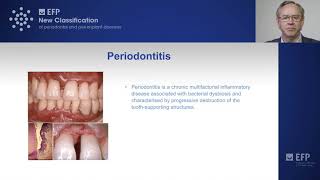 New classification of periodontitis [upl. by Widera]