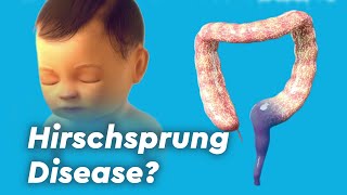 Intussusception Treatment video  Animaton by Cal Shipley MD [upl. by Rothstein]