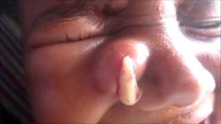 Abscess On Side Of Nose [upl. by Corbet]