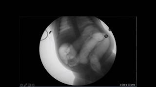 Pediatric Emergency POCUS Targeting Intussusception [upl. by Yekcim804]