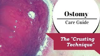 The Ostomy Crusting Technique Explained [upl. by Aeiram]